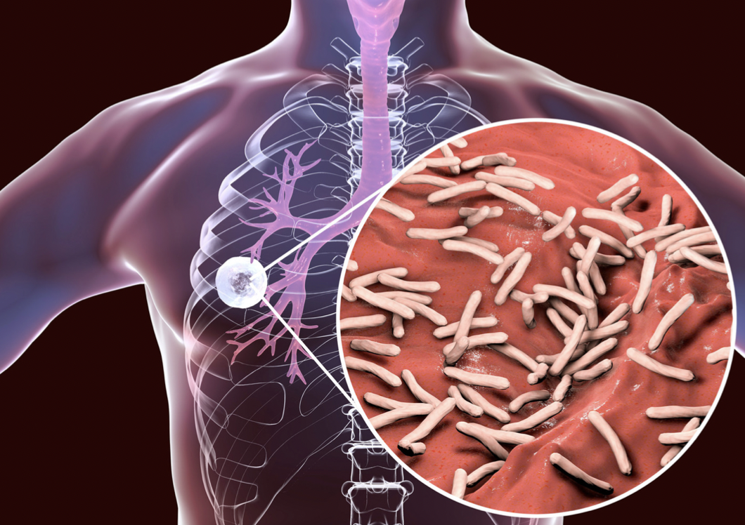 Tuberkulosis (TB) Paru